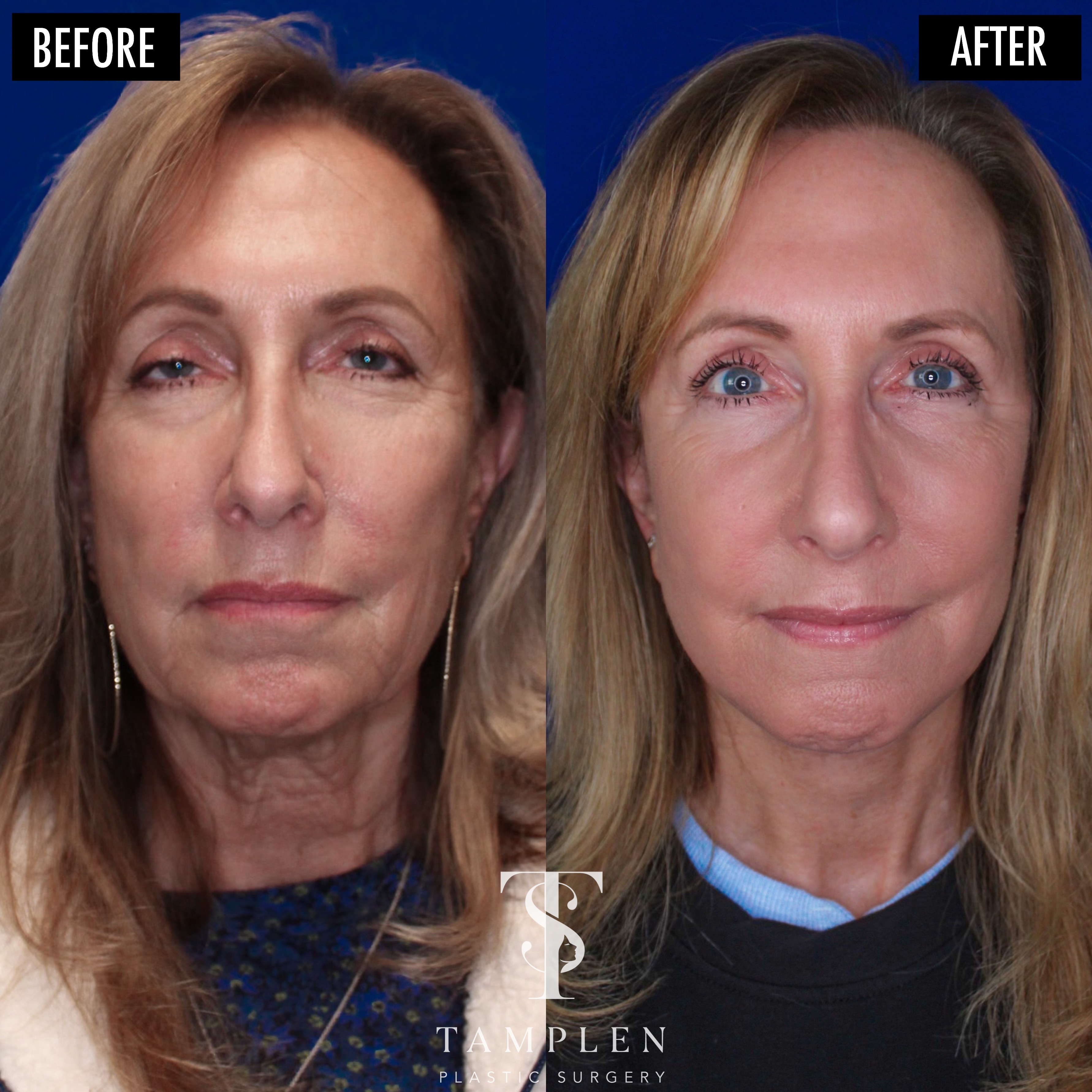 Tamplen Plastic Surgery Before & After Image