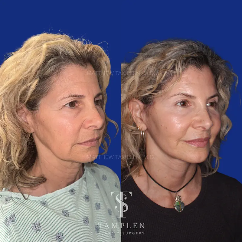 Additional photo 1 - Facelift