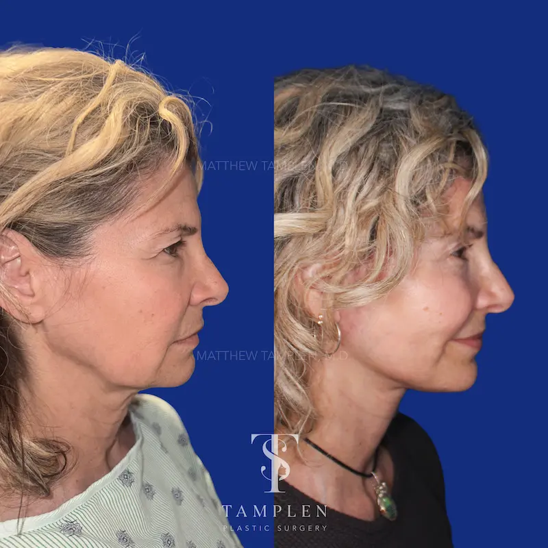 Additional photo 2 - Facelift