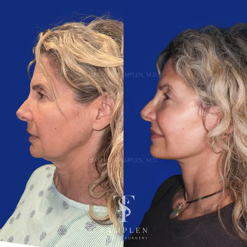 Additional photo 3 - Facelift