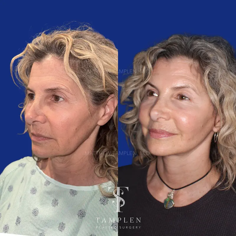 Additional photo 4 - Facelift