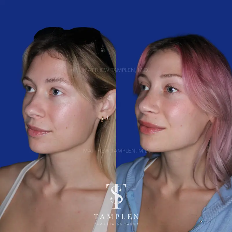 Additional photo 1 - Primary Rhinoplasty