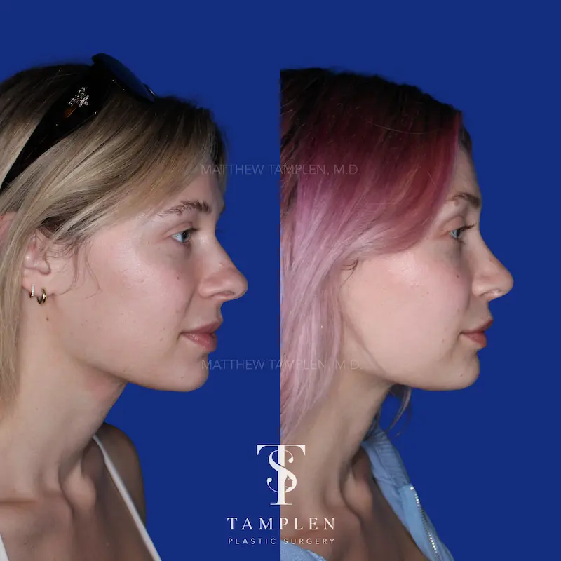 Additional photo 2 - Primary Rhinoplasty