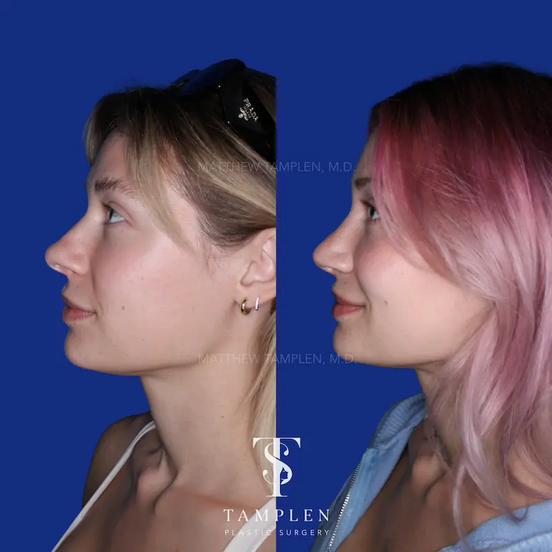 Additional photo 3 - Primary Rhinoplasty