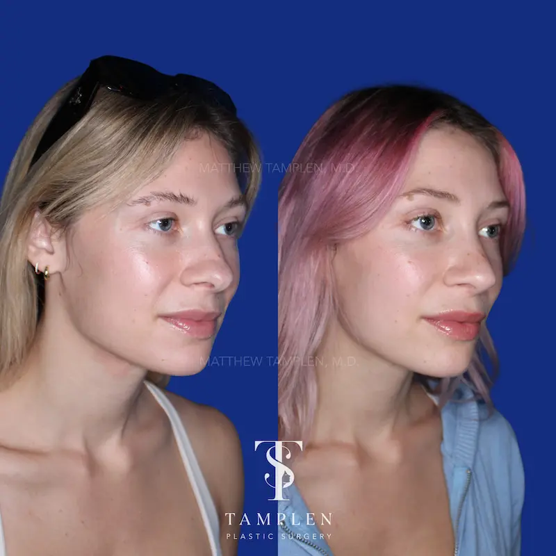 Additional photo 5 - Primary Rhinoplasty