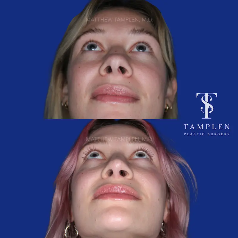 Additional photo 6 - Primary Rhinoplasty