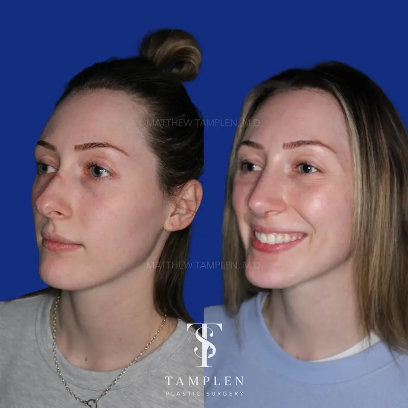 Additional photo 1 - Primary Rhinoplasty