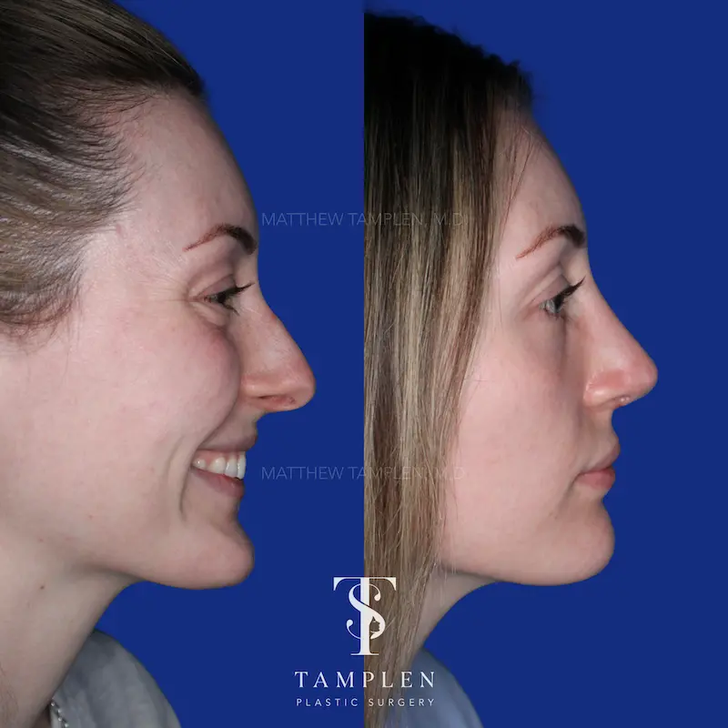 Additional photo 2 - Primary Rhinoplasty