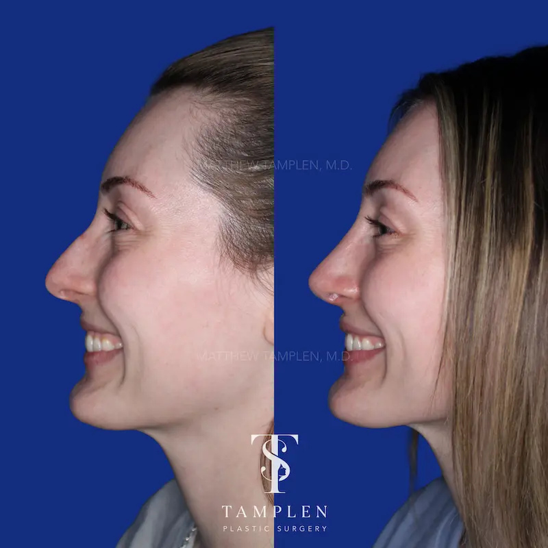 Additional photo 3 - Primary Rhinoplasty