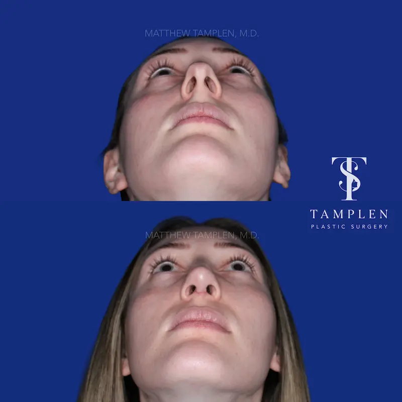 Additional photo 4 - Primary Rhinoplasty