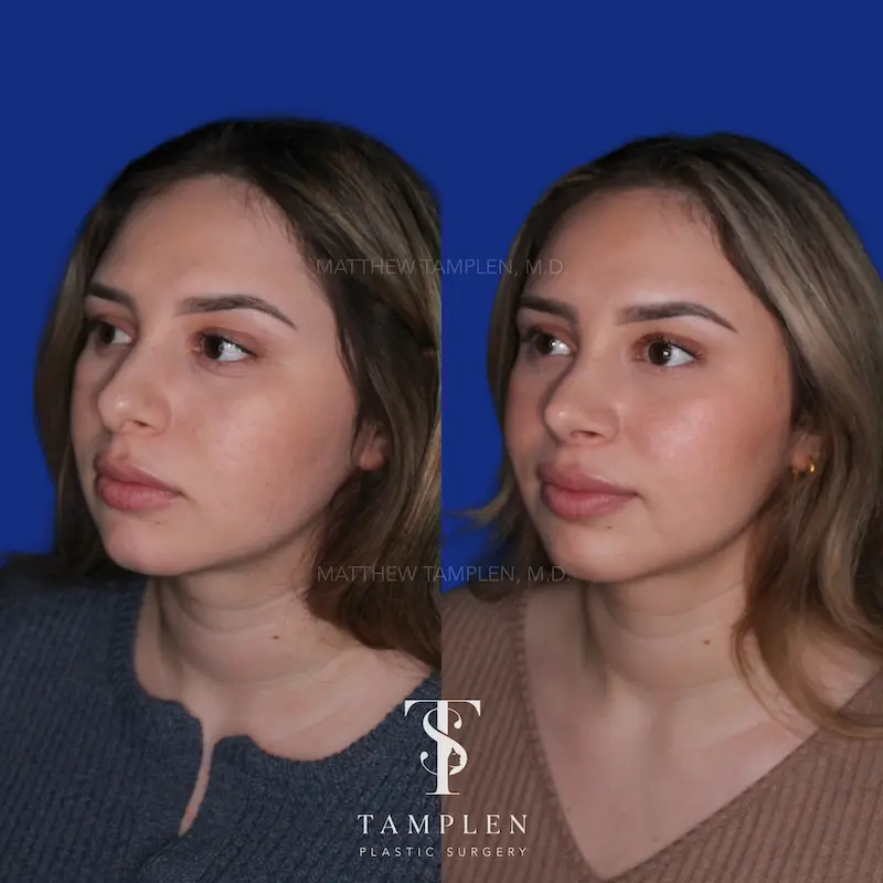 Additional photo 1 - Primary Rhinoplasty