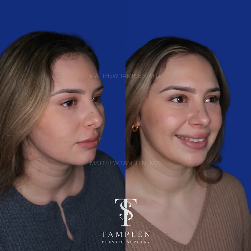 Additional photo 2 - Primary Rhinoplasty