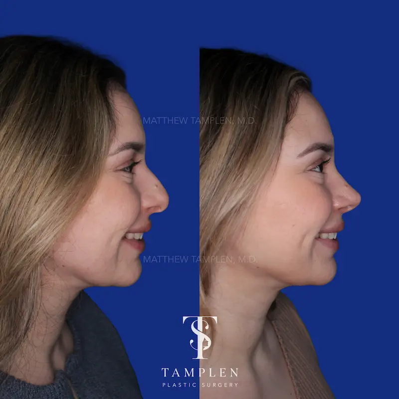 Additional photo 3 - Primary Rhinoplasty