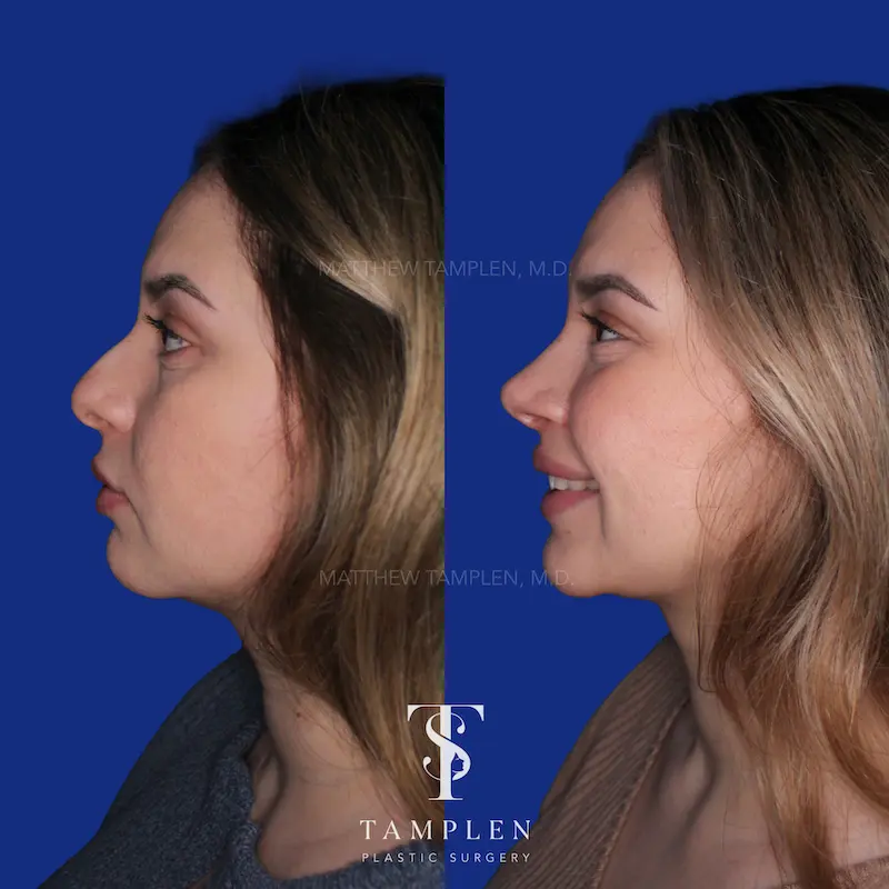 Additional photo 4 - Primary Rhinoplasty