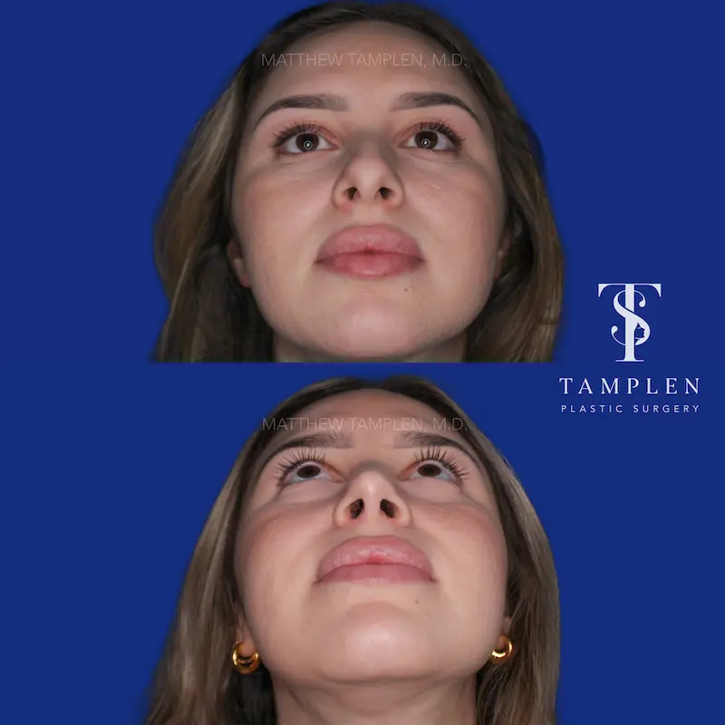 Additional photo 5 - Primary Rhinoplasty