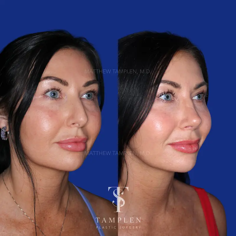 Additional photo 1 - Primary Rhinoplasty