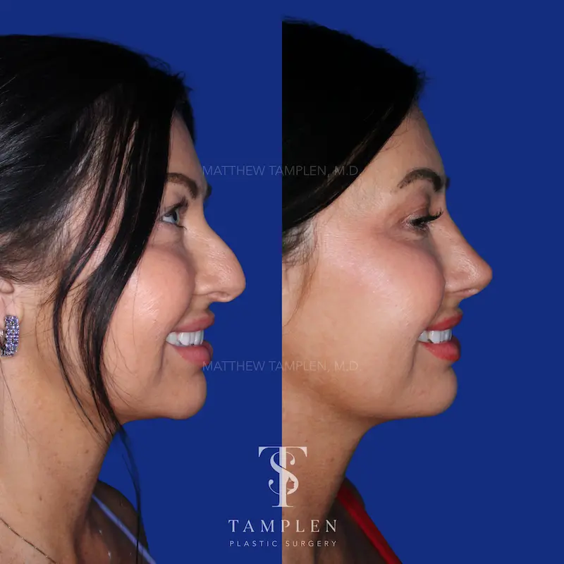 Additional photo 2 - Primary Rhinoplasty