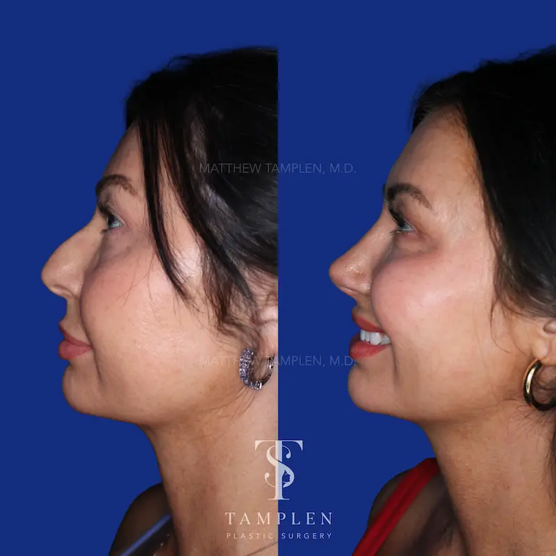 Additional photo 3 - Primary Rhinoplasty