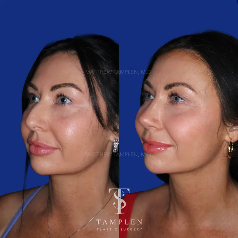 Additional photo 4 - Primary Rhinoplasty