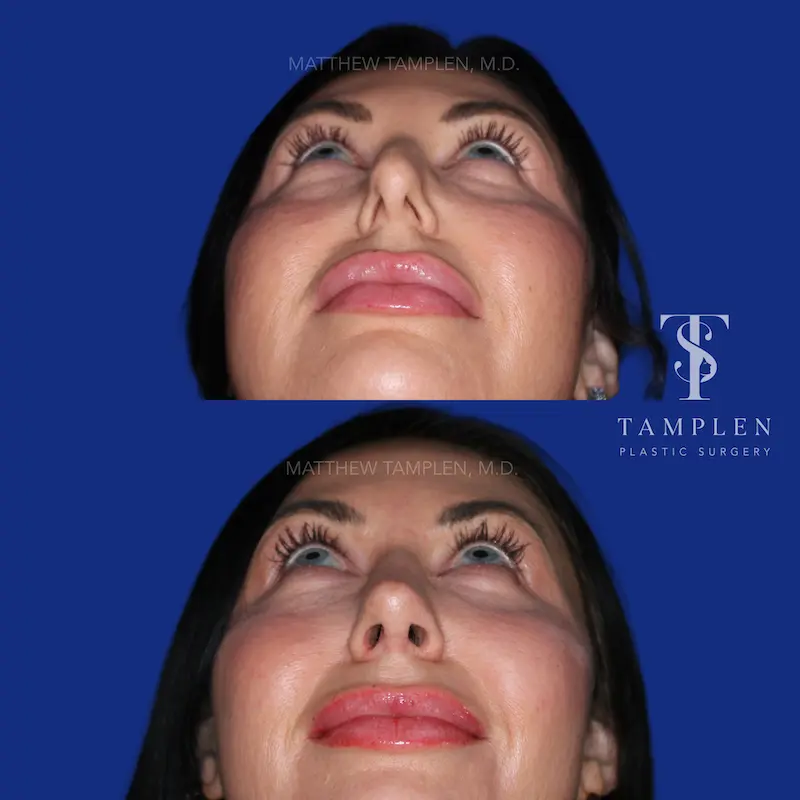 Additional photo 5 - Primary Rhinoplasty