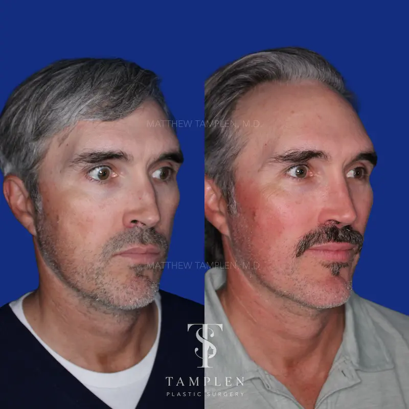 Additional photo 1 - Male Rhinoplasty