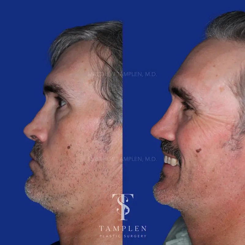 Additional photo 2 - Male Rhinoplasty