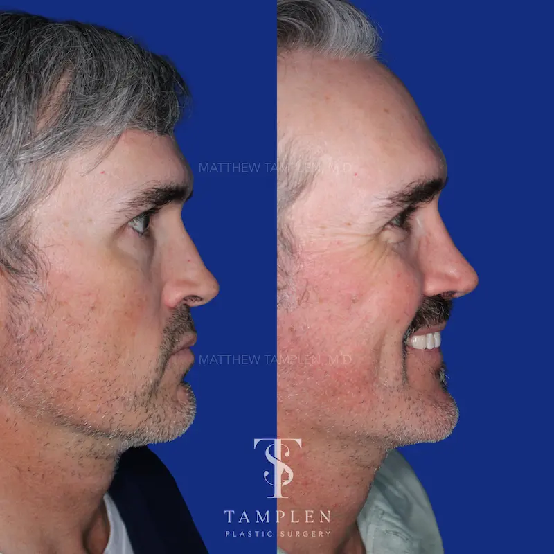 Additional photo 3 - Male Rhinoplasty
