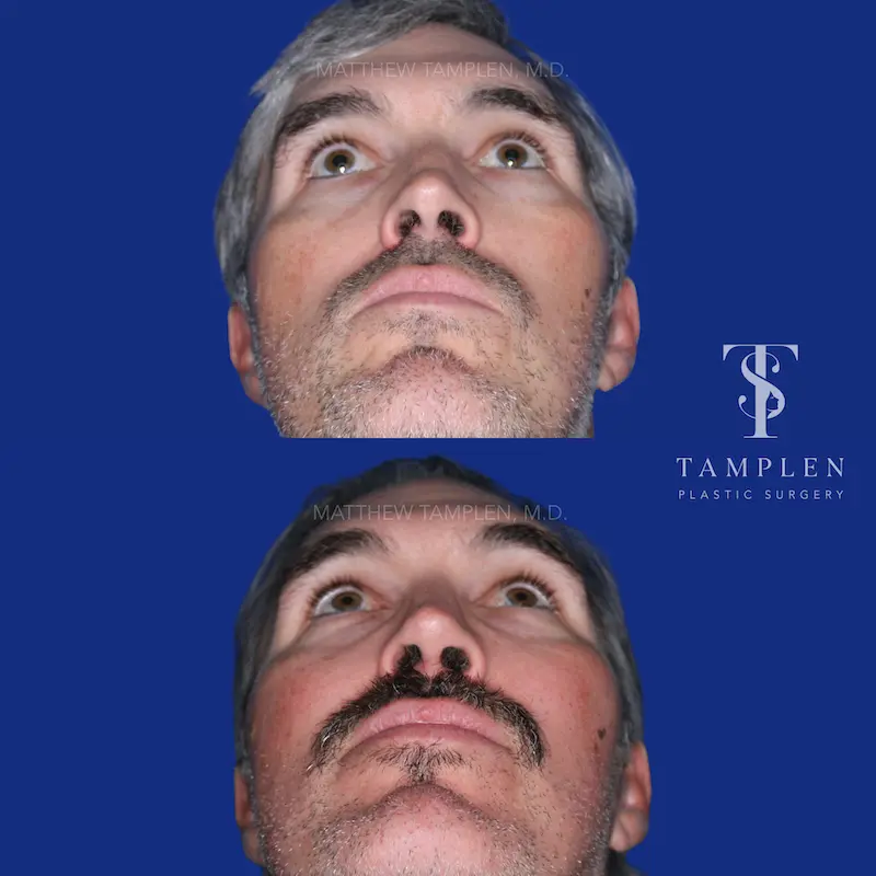 Additional photo 5 - Male Rhinoplasty