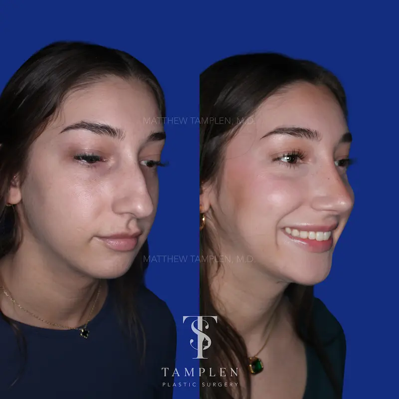 Additional photo 1 - Primary Rhinoplasty