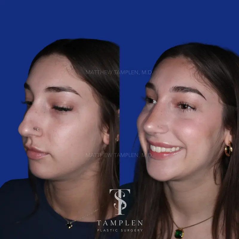 Additional photo 2 - Primary Rhinoplasty