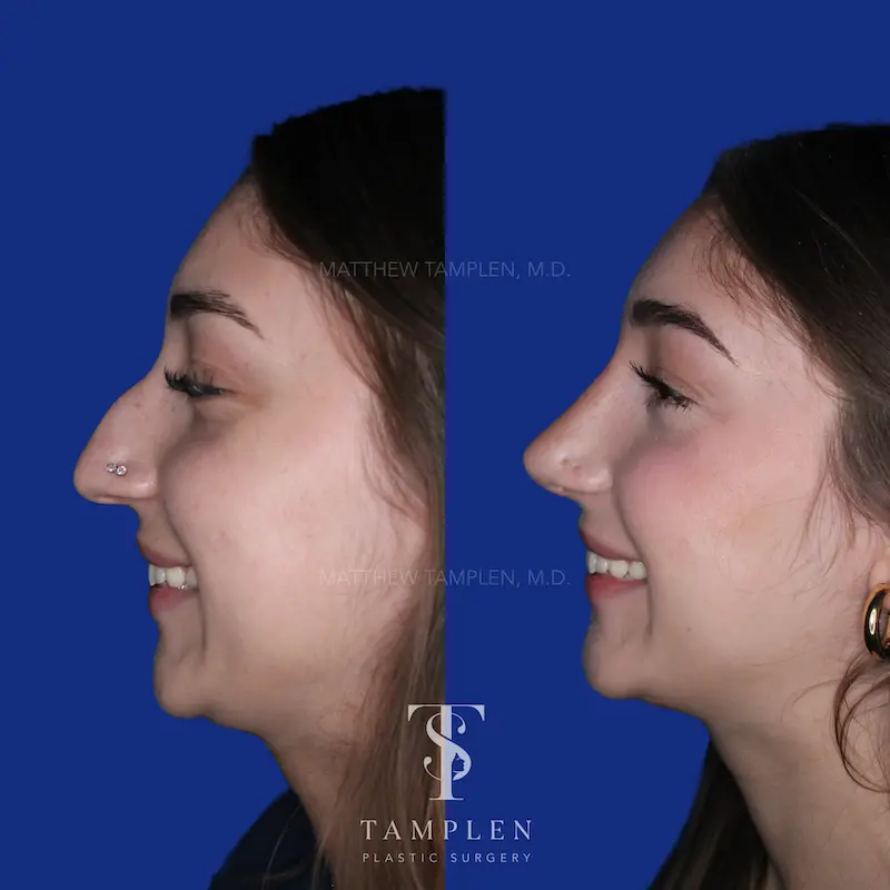 Additional photo 3 - Primary Rhinoplasty