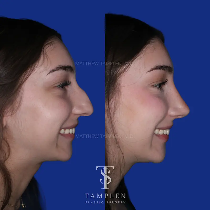 Additional photo 4 - Primary Rhinoplasty