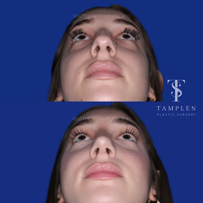 Additional photo 5 - Primary Rhinoplasty
