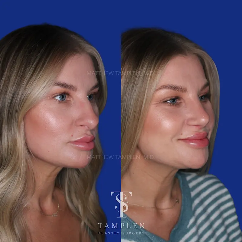 Additional photo 1 - Primary Rhinoplasty