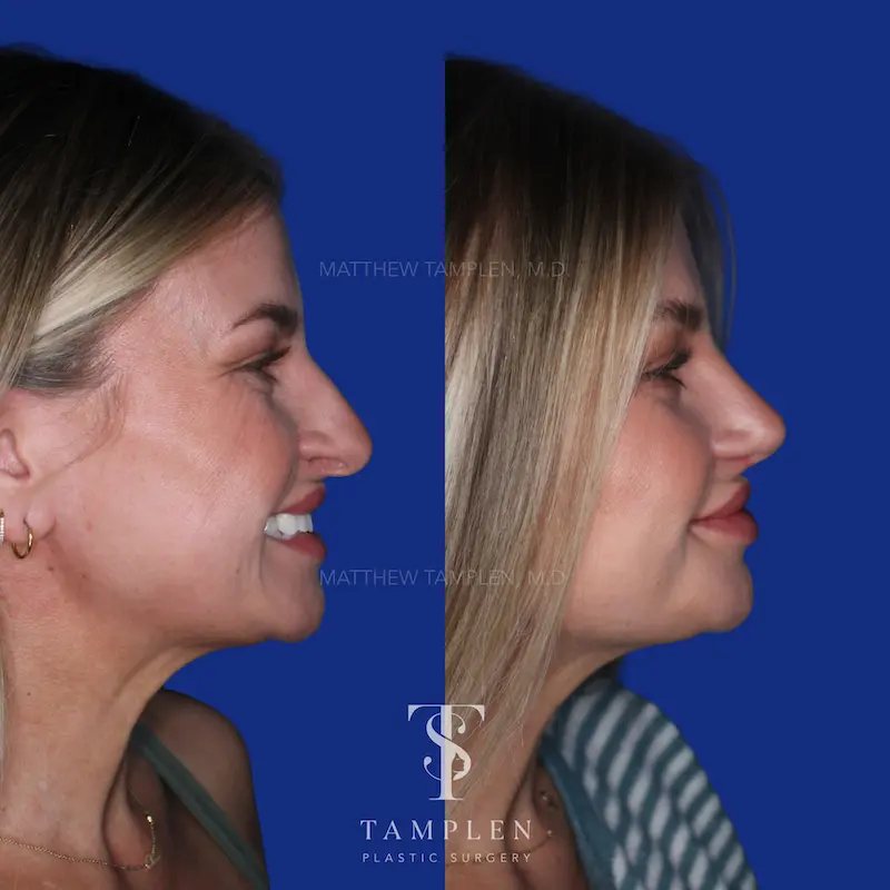 Additional photo 3 - Primary Rhinoplasty