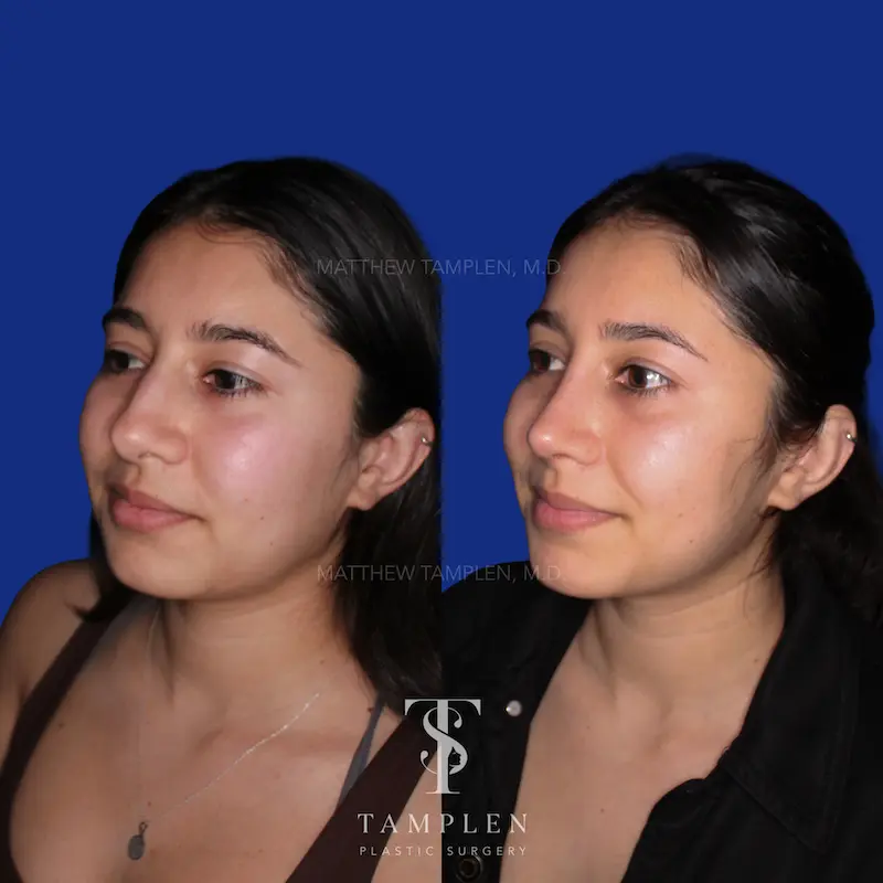Additional photo 1 - Primary Rhinoplasty