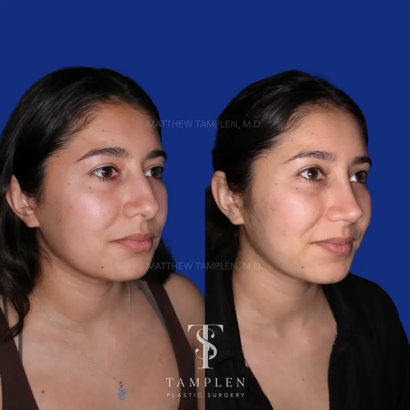 Additional photo 2 - Primary Rhinoplasty