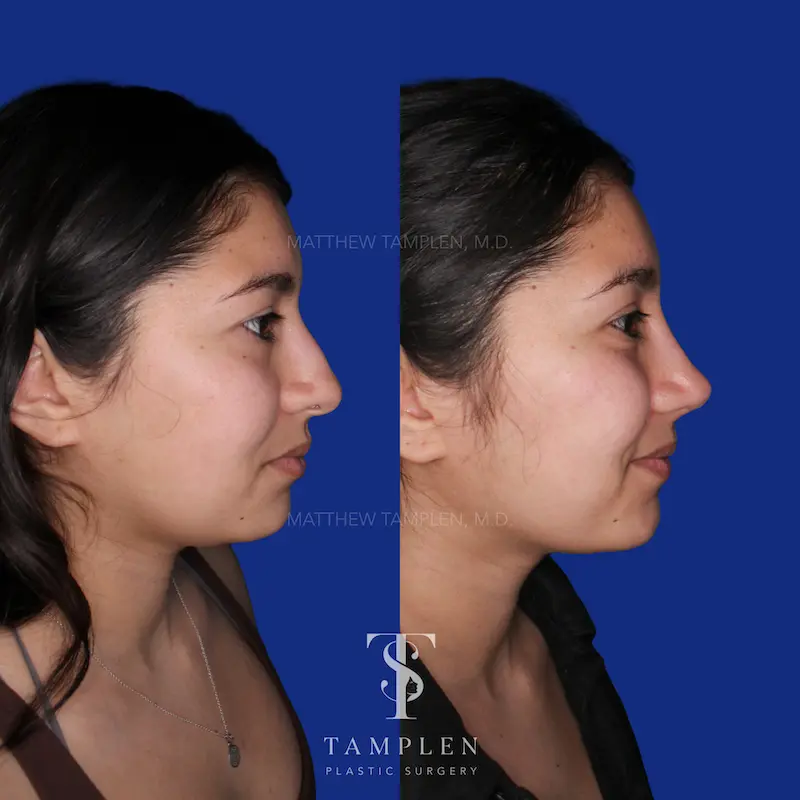 Additional photo 3 - Primary Rhinoplasty