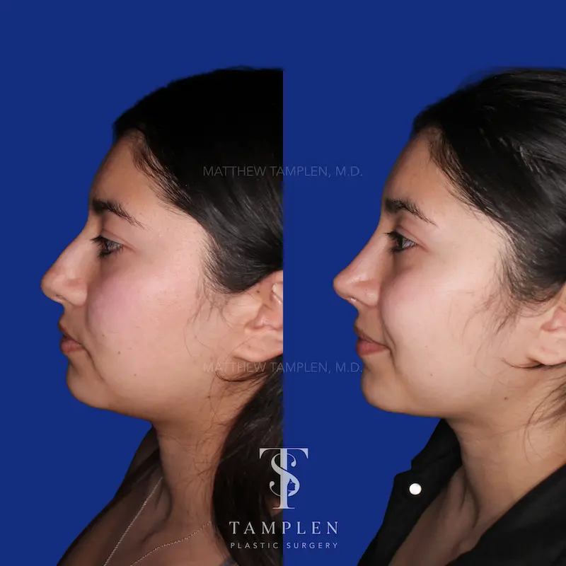 Additional photo 4 - Primary Rhinoplasty