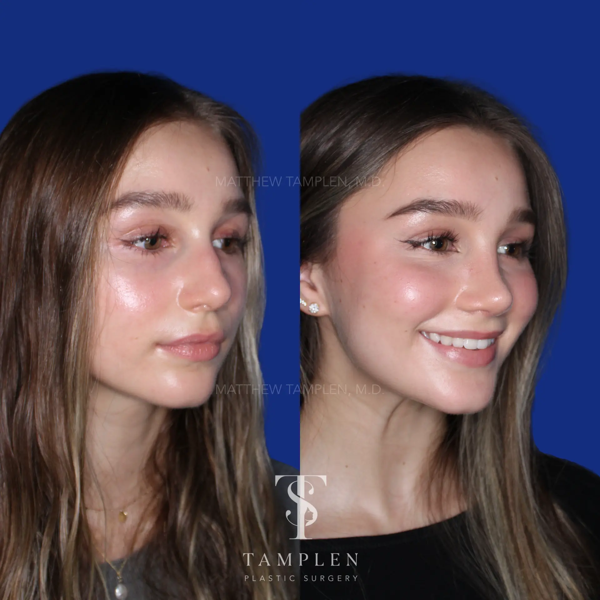 Additional photo 1 - Primary Rhinoplasty
