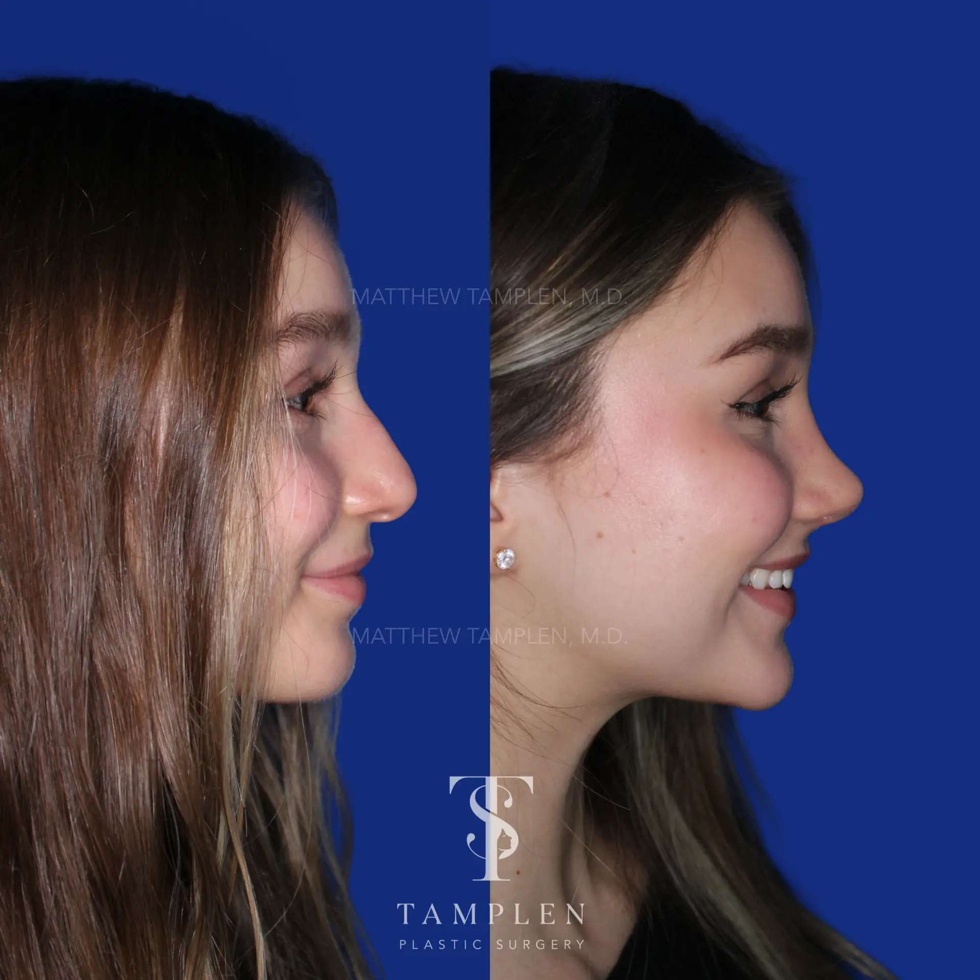 Additional photo 3 - Primary Rhinoplasty