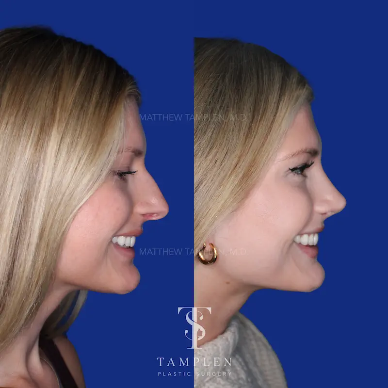 Primary Rhinoplasty additional result photo 1