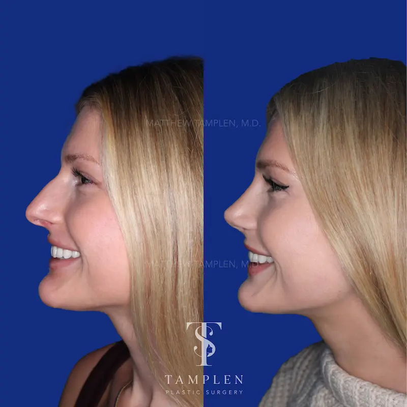 Primary Rhinoplasty additional result photo 2
