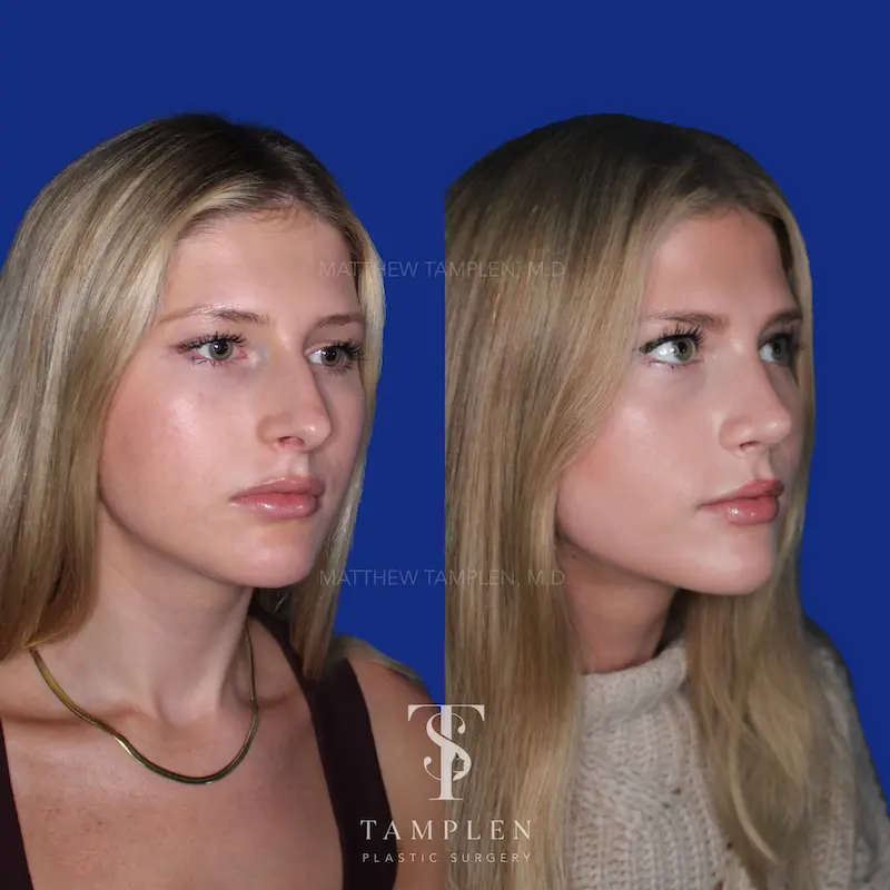 Primary Rhinoplasty additional result photo 3