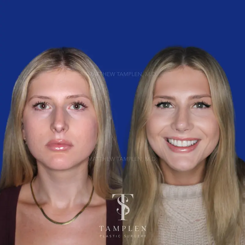 Primary Rhinoplasty additional result photo 4