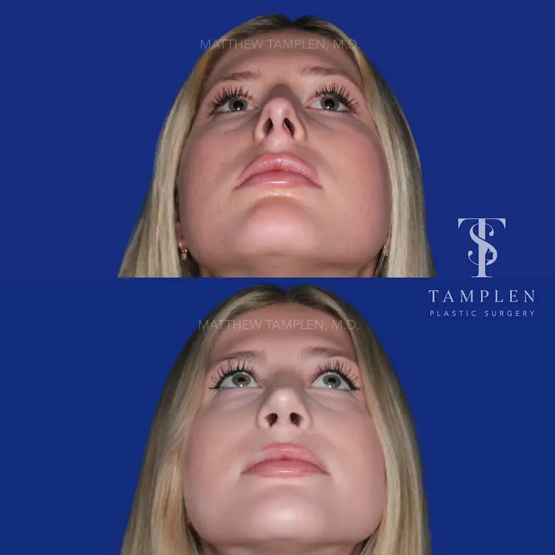Primary Rhinoplasty additional result photo 5