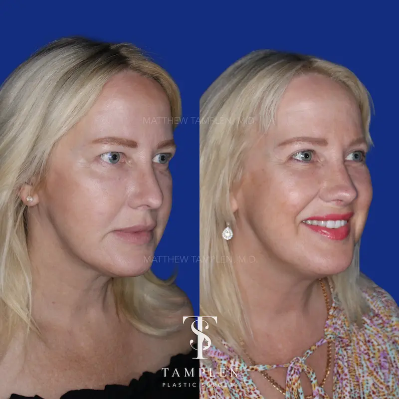 Additional photo 1 - Female Rhinoplasty