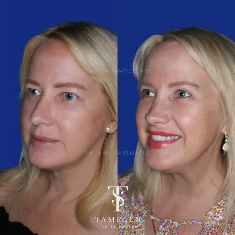 Additional photo 2 - Female Rhinoplasty