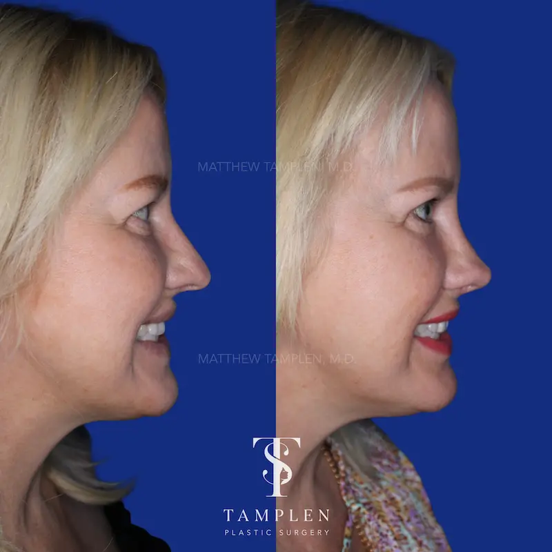 Additional photo 3 - Female Rhinoplasty