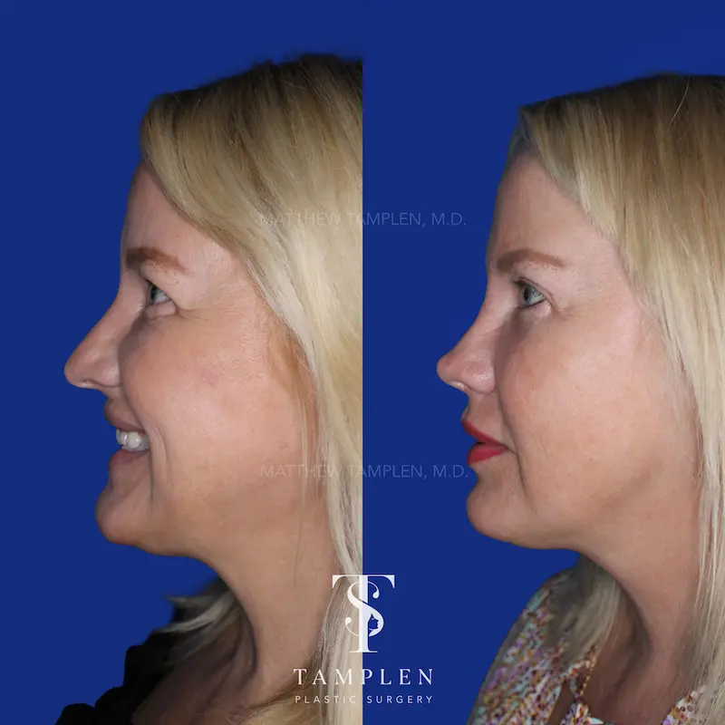 Additional photo 4 - Female Rhinoplasty